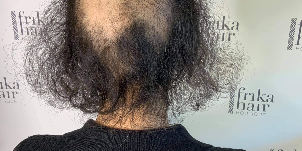 Regain Confidence with Natural-Looking Wigs for Hairloss